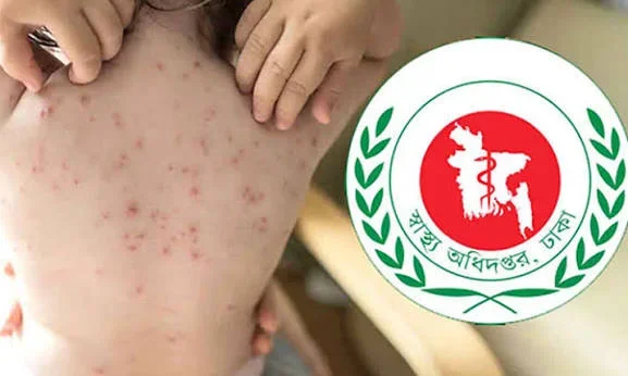 ২৪ ঘণ্টায় হামের উপসর্গে ৫ মৃত্যু, নতুন সন্দেহজনক রোগী ১,০৮৪