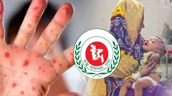 হামের উপসর্গে আরও ৬ শিশুর মৃত্যু, মোট প্রাণহানি ১ হাজার ৩৬