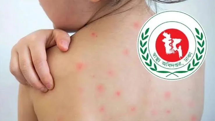 হামের উপসর্গে আরও ৭ জনের মৃত্যু, মোট প্রাণহানি ১ হাজার ১৯